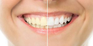 Cosmetic Dentistry- Powerful Technology Can Give You Your Best Smile